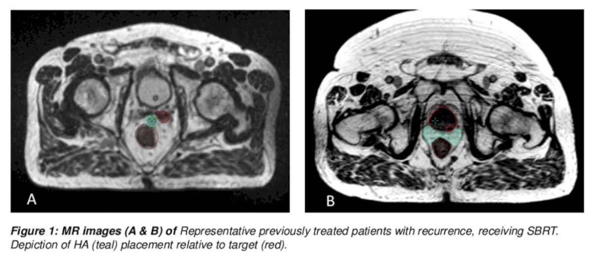 This study was a retrospective review of 23 patients at a single institution with recurrent prostate cancer localized to the prostate, seminal vesicles, and/or prostate fossa with prior local therapy including external beam radiotherapy, brachytherapy, or cryoablation +/- prostatectomy