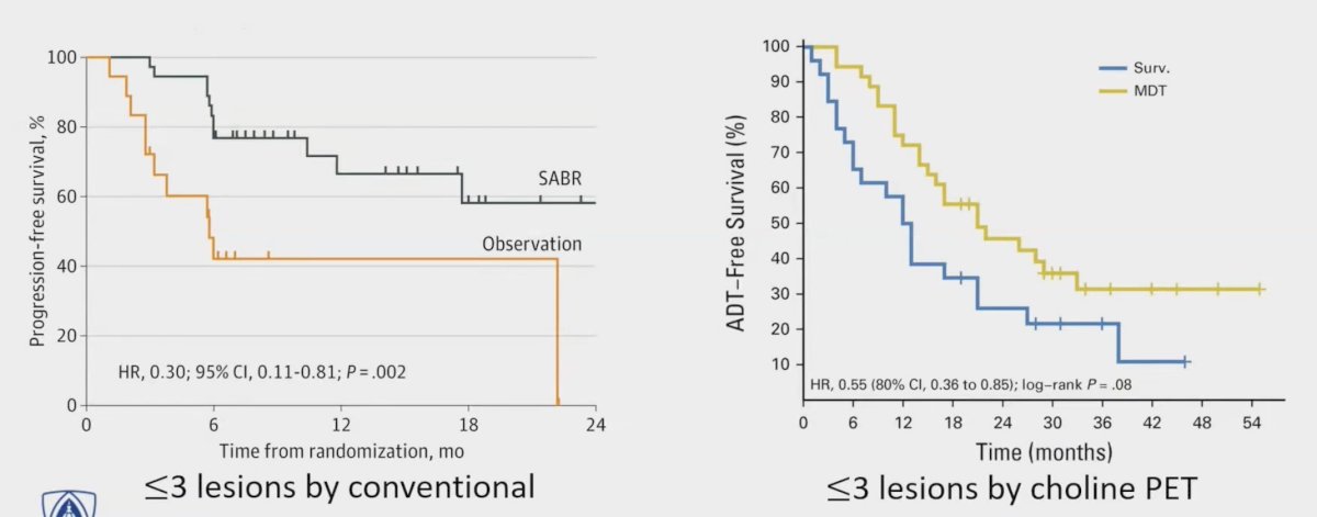 Previously, the STOMP1 and ORIOLE2 randomized clinical trials showed progression-free survival benefits of metastasis-directed therapy alone without ADT for oligometastatic hormone-sensitive prostate cancer
