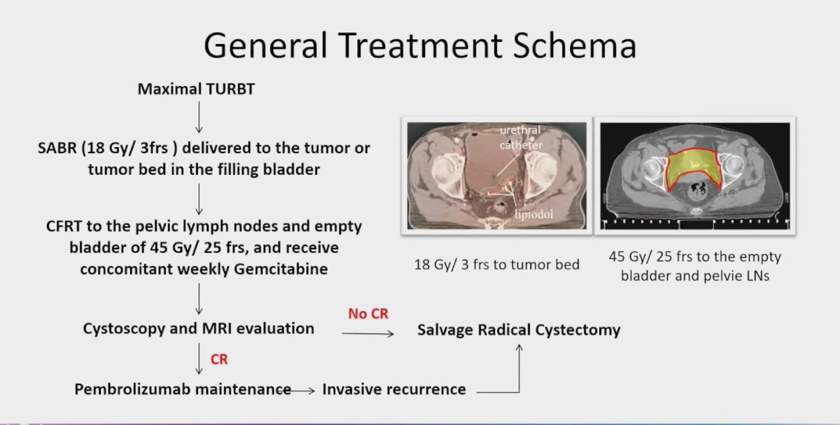 participants underwent maximal transurethral resection of bladder tumor (TURBT) followed by SABR at a dose of 18 Gy in 3 fractions, delivered to the tumor or tumor bed within the filling bladder. Concurrently, patients received conventionally fractionated radiotherapy (CFRT) to the pelvic lymph nodes and empty bladder, totaling 45 Gy in 25 fractions, along with weekly Gemcitabine