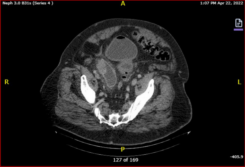 a case of a 69 year old man who presented with gross hematuria, described as 6 weeks of intermittent, painless, gross hematuria with intermittent obstructive lower urinary tract symptoms