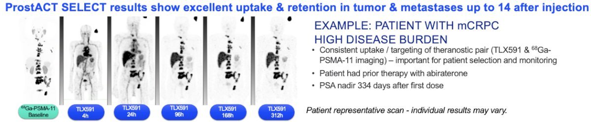 TLX591 utilizes&nbsp;a PSMA-targeted monoclonal antibody (mAb) approach. mAbs are highly specific with low rates of off-target organ exposure, demonstrate prolonged retention in PSMA-positive tumors, and have a predictable safety profile. Two treatments are administered 14 days apart