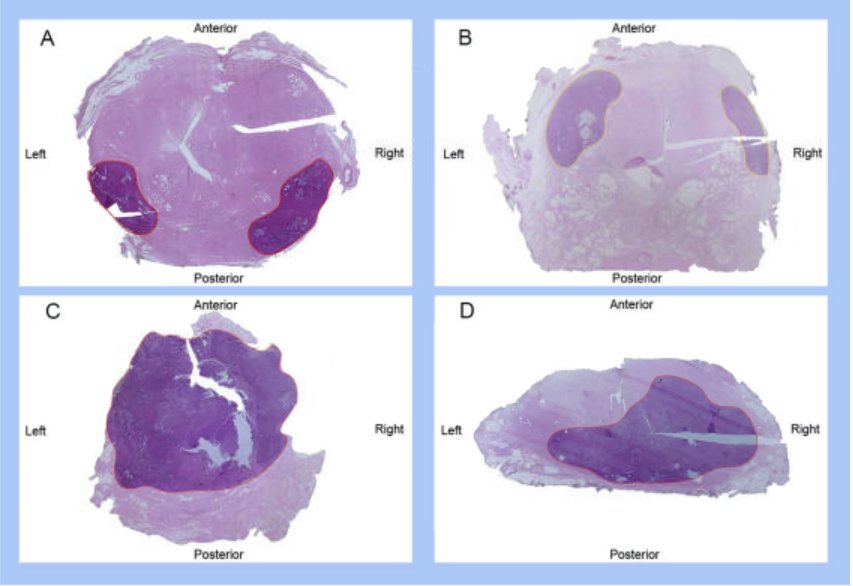 Several studies have looked at post-salvage radical prostatectomy specimens to see if patients would have been candidates for focal therapy. Marra and colleagues3 assessed 41 men that underwent salvage radical prostatectomy via whole mount review, looking at tumor location, volume, and grade