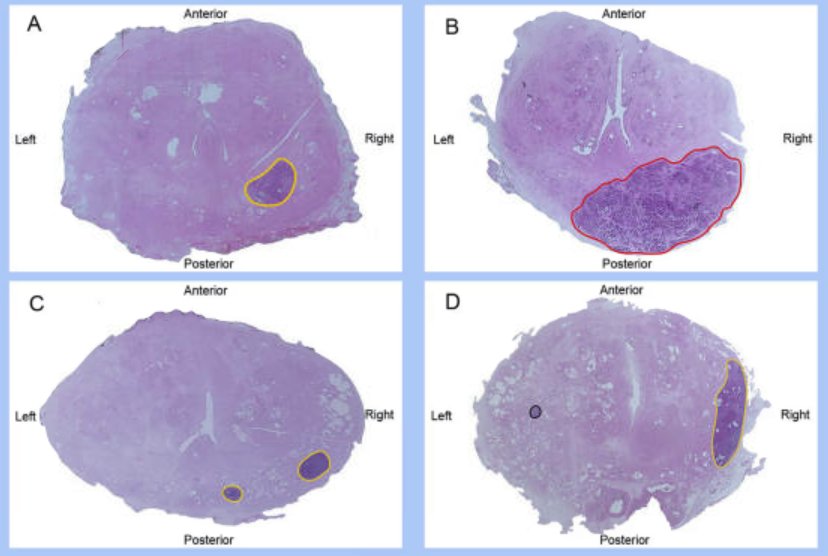 Candidates for focal therapy were those that had: a unifocal lesion, unilateral lesion with <50% on the contralateral side (hockey stick), 2 foci on the ipsilateral side, or 2 foci, one that is clinically relevant. Overall, 56% of men were deemed eligible for salvage focal therapy
