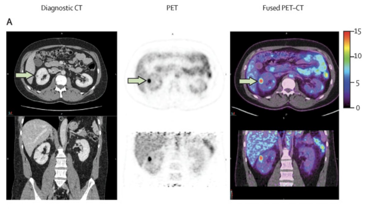 A modern clinical or radiological predictor could be [89Zr]Zr-girentuximab PET/CT. In the ZIRCON study, this imaging modality demonstrated a sensitivity of 85.5% and specificity of 87.0% for clear cell RCC. (3) If used correctly, it could help inform clinical decision-making in the future and potentially predict response to treatment.&nbsp;