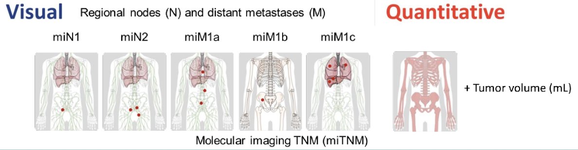PSMA-PET was standardized by molecular imaging TNM. Total tumor volume, PSMA expression score and overall survival follow-up were obtained. The cohort was randomly split 2:1 into development and validation cohorts. In the development cohort the investigators assessed PPP2 predictors and created visual and quantitative PPP2 nomograms based on Cox regression models with least absolute shrinkage and selection operator penalty for overall survival: