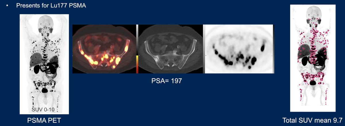Dr. Surasi started with a case of a 74 year old with mCRPC status post ADT, 6 cycles of docetaxel, enzalutamide, and palliative radiotherapy to the prostate, the right clavicle, and L3/L4. The patient’s medical history included hypertension, hyperlipidemia, and lymphoplasmacytic lymphoma. This patient subsequently presented for 177Lu-PSMA with a PSA of 197 ng/mL: