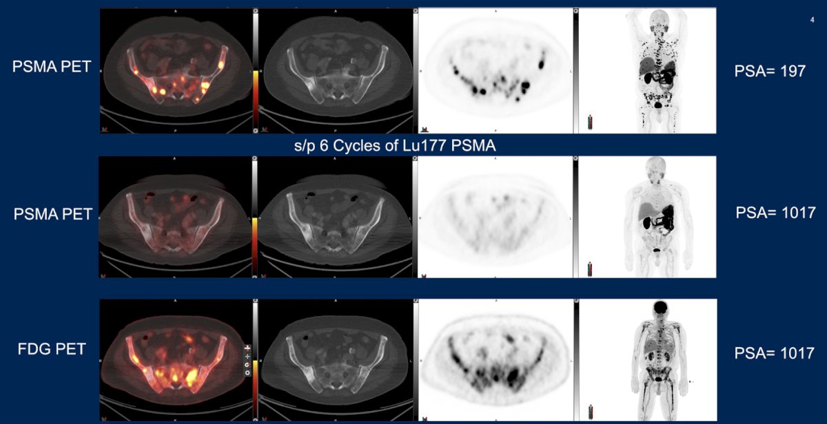 Unfortunately, after 6 cycles of 177Lu-PSMA-617, the patient’s disease progressed (PSA 1,017 ng/mL):
