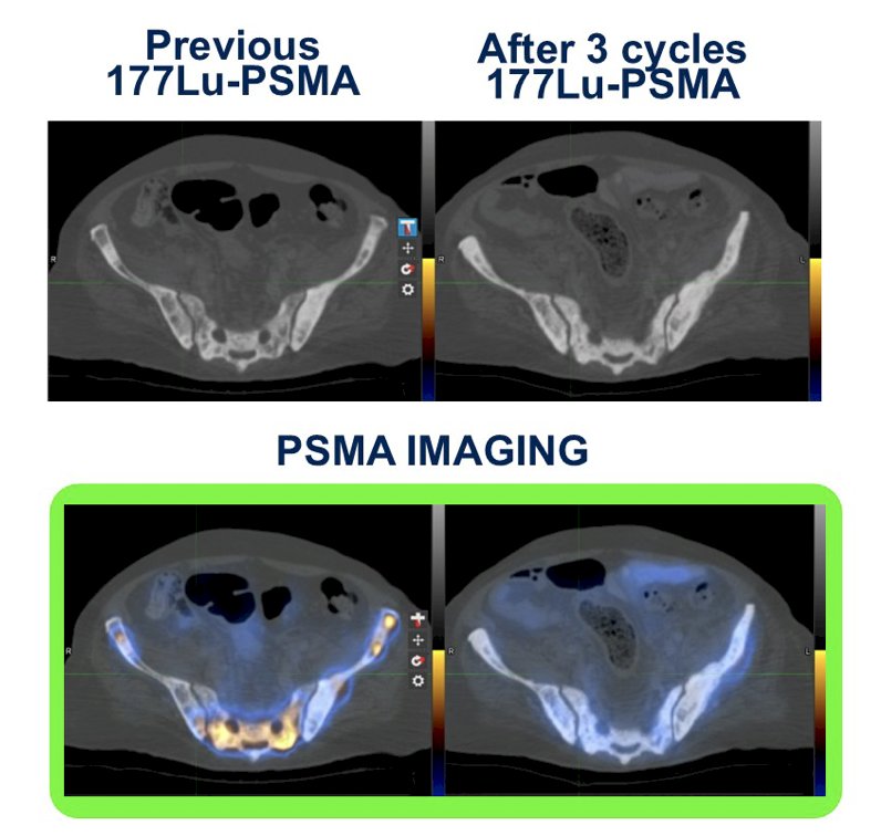 According to PCWG3, imaging with bone scans and CT/MRI should be done every 12 weeks when assessing patients in metastatic prostate cancer clinical trials. But, does vintage imaging really help in assessing radioligand therapy? Dr. Cortes cautions that relying on a vintage imaging approach alone is not enough and PSMA PET imaging should also be incorporated: