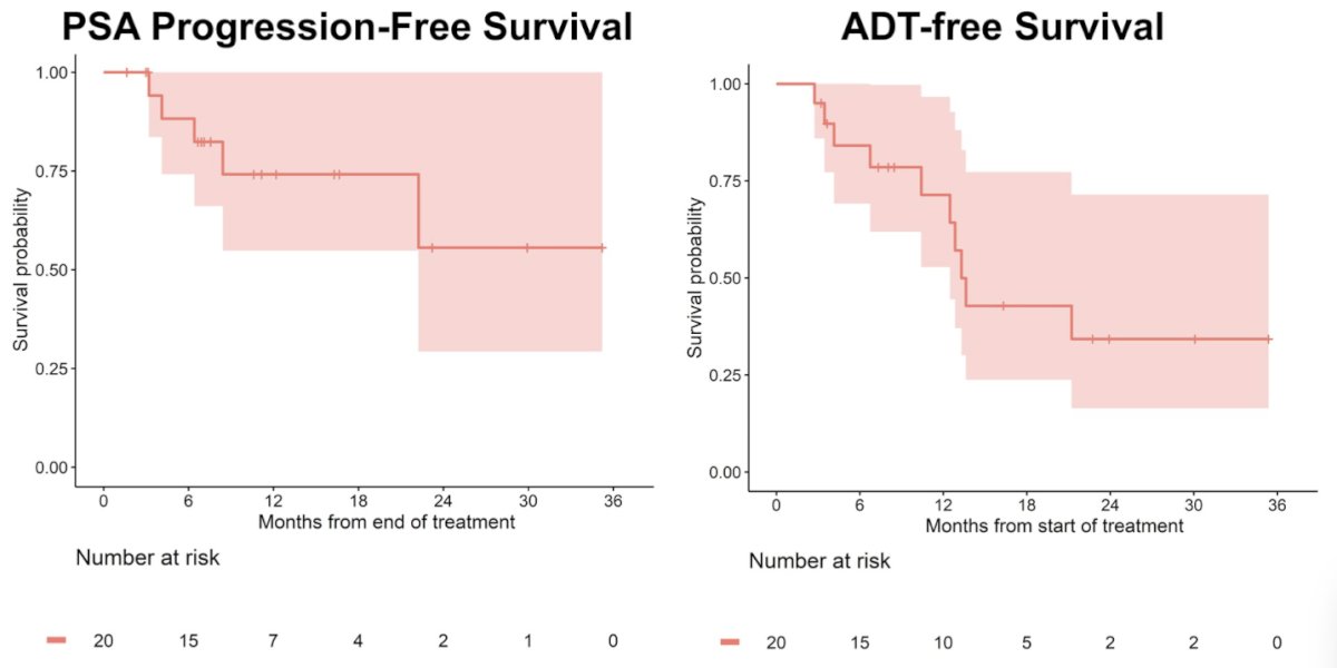  Overall, 85% of patients had a prior lymph node dissection, 35% had positive margins, and 45% had adjuvant/salvage radiotherapy + ADT. &nbsp;The mean number of PET identified lymph nodes (Group B) was 1.8 (range: 1-6), and the number of lymph nodes identified on pathology was a mean 5.1 (range: 1-31). The primary endpoint of reduction in PSA by ≥&nbsp;50% at 6 months was 40% (95% CI 19-64%). The secondary endpoint of PSA progression free-survival at 12 months was 74.1% (95% CI 54.8-100%), and ADT-free survival at 12-months was 71.4% (95% CI 52.7% - 96.6%):  &nbsp;