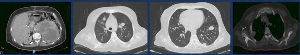 Next, Dr. Lallas presented the 2nd case of a 38-year-old female who presented with a 6 month history of fatigue, weight loss, and mild dyspnea. She was found to have a renal mass invading the renal vein, multiple pulmonary nodules, and mediastinal lymphadenopathy.