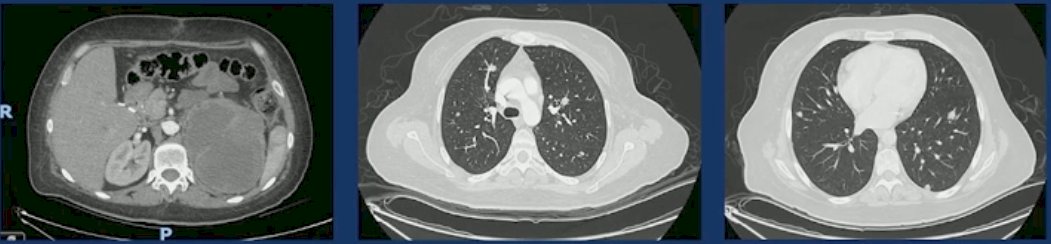 She was started on cabozantinib + nivolumab and achieved a partial response.