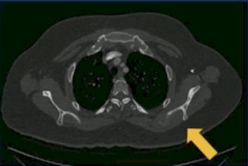 16 months after completion of cabozantinib + nivolumab, with a maintained partial response in the primary and metastatic lesions, she was found to have a novel left scapular lesion, as imaged below: