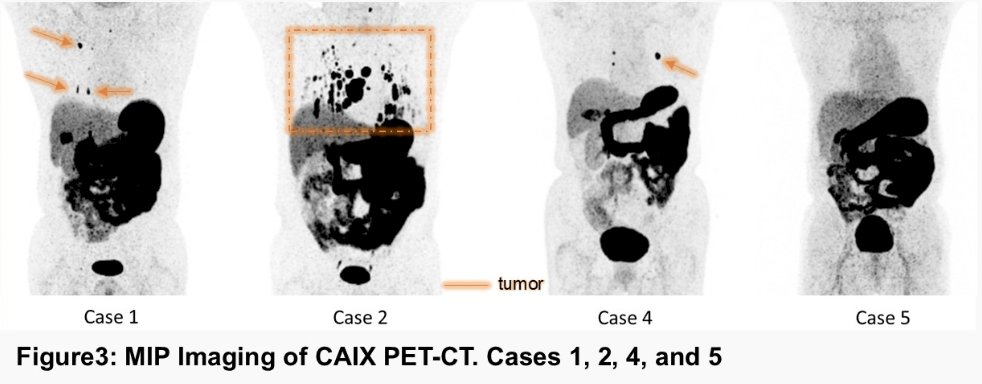 &nbsp;64Cu-PD-32766 demonstrated good tolerability, with no serious complications noted. The mean patient-level PET uptake positivity rate at 120 minutes was 75%, and the mean lesion-level PET positivity rate was 96.2%: