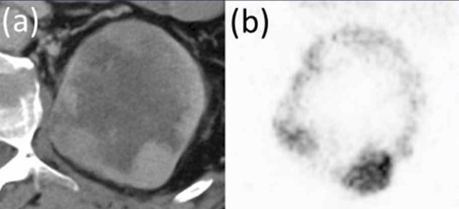 Tumor uptake was highest at 60 and 120 minutes post-administration. The effective dose for whole body was 0.102 ± 0.036 mSv/MBq. The following figure shows a typical image of ccRCC on CAIX PET CT: