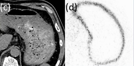 The stomach and small intestine had the highest absorbed doses among all organs, with 0.712 ± 0.287 mGy/MBq and 0.304 ± 0.067 mGy/MBq, respectively. The following shows uptake in the stomach: