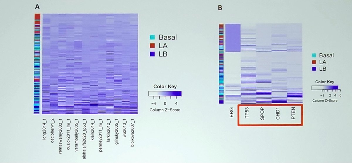Decipher scores were lowest in the Luminal A group, followed by the Basal group, and highest in the Luminal B group. Intra-patient variability based on subtyping of different cores within the same biopsy was observed in 37.1% of cases. Transcriptome analysis revealed distinct enrichment profiles for each PAM50 subtype, and mutation pattern analysis highlighted differences in mutation associations, with the Luminal B subtype showing a stronger association with SPOP and PTEN mutations