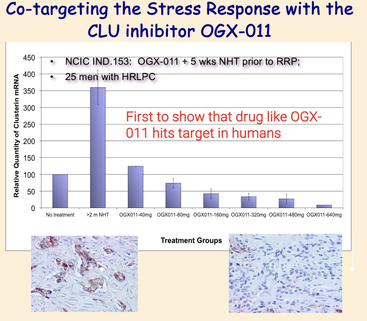 They were the first to demonstrate that a drug like OGX-011 effectively hits its target in humans. Interestingly, induction of the ER stress markers ATF4 and GRP78 was not affected by YB-1 silencing, suggesting that YB-1 was not a general upstream activator of these ER stress markers but rather specifically upregulated CLU
