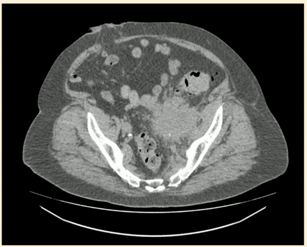 There was no evidence of disease recurrence on surveillance CT imaging performed at 3 and 6 months post-operatively. But, at 12 months, the patient was found to have a left pelvic recurrence (no other sites of disease spread) and was otherwise asymptomatic.
