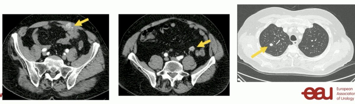 A follow-up CT scan 6 months post-salvage resection demonstrated 2 enhancing masses in the abdominal wall and 1 nodule (15 mm) in the right lung. eGFR at this point was 43 ml/min/1.73m2