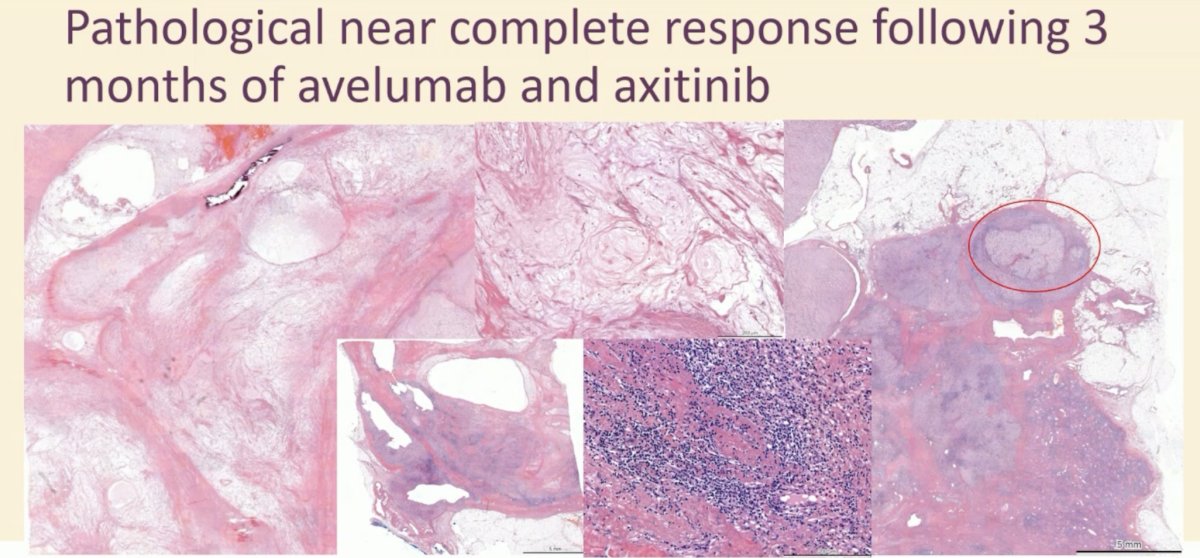 Among the 12 patients with a partial response of the primary tumor, 10 (83%) were disease-free. At a median follow-up of 23.5 months, recurrence occurred in 13 (32%) patients at a median of 8 months, and 3 died of disease. Neither median disease-free survival nor overall survival has been reached to date