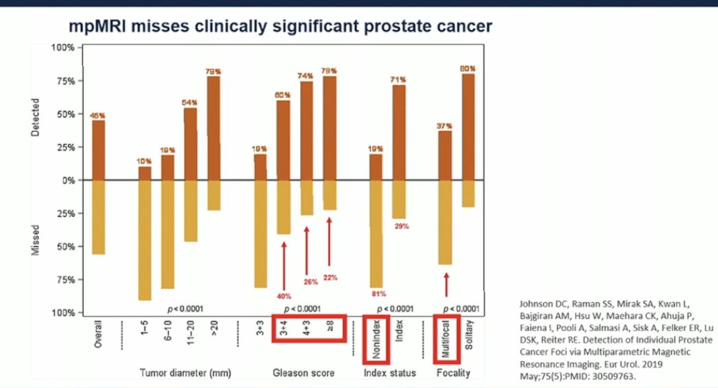 The applicability of focal therapy depends on the "clinical significance" of the prostate cancer, including factors such as multifocality, tumor volume, and biological aggressiveness. Data suggest that suboptimal patient selection remains a challenge. Often, we observe that mpMRI misses clinically significant prostate cancer when compared to radical prostatectomy surgical pathology, leading to disease upgrading at the time of surgery.