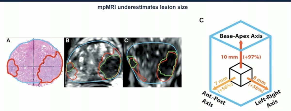 Moreover, MRI tends to underestimate the size of the target lesion, raising concerns about missing part of the treatment area and questioning what margin should be applied during focal therapy. From an imaging standpoint, we are still not fully there in accurately identifying ideal candidates for focal therapy.