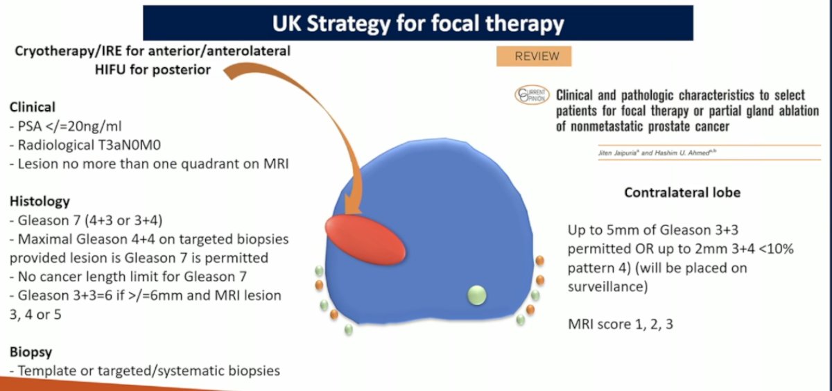 Additionally, up to 5 mm of Gleason 3+3 disease or up to 2 mm of Gleason 3+4 with <10% pattern 4 is permitted, with these patients being placed on active surveillance.