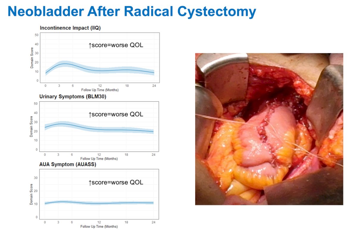 Urinary quality of life appeared to improve over time, whether in the urostomy symptoms domain among ileal conduit patients or across various measures of urinary quality of life in orthotopic neobladder patients as shown in the graphics below.