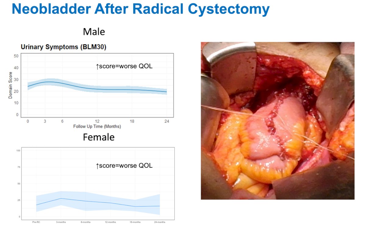 Comparing the urinary symptoms domain between male and female patients who underwent neobladder reconstruction after radical cystectomy, urinary quality of life appeared similar between sexes and improved over time.