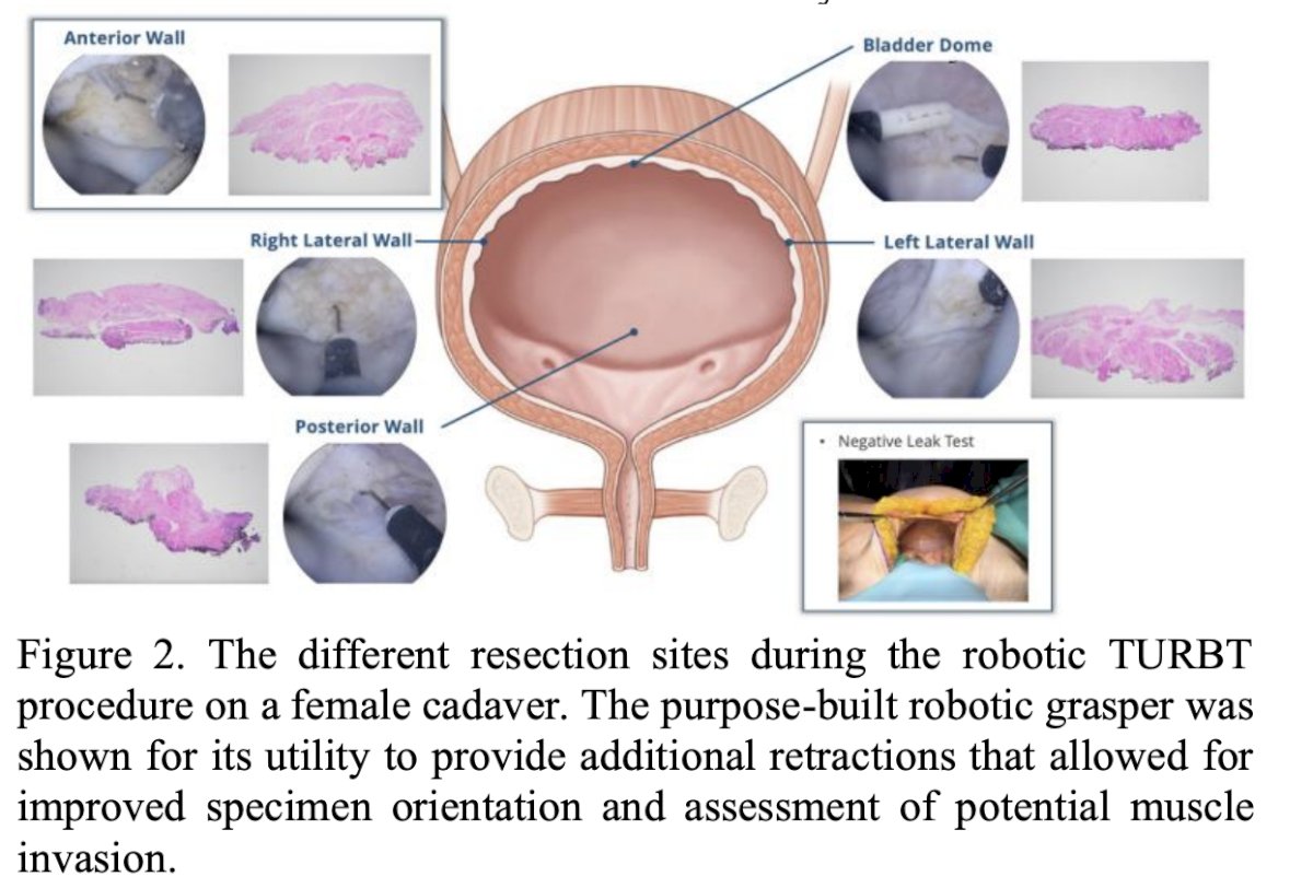 The surgeons were tasked with resecting multiple regions of the bladder, including the posterior wall, anterior wall, bladder dome, and left and right lateral walls