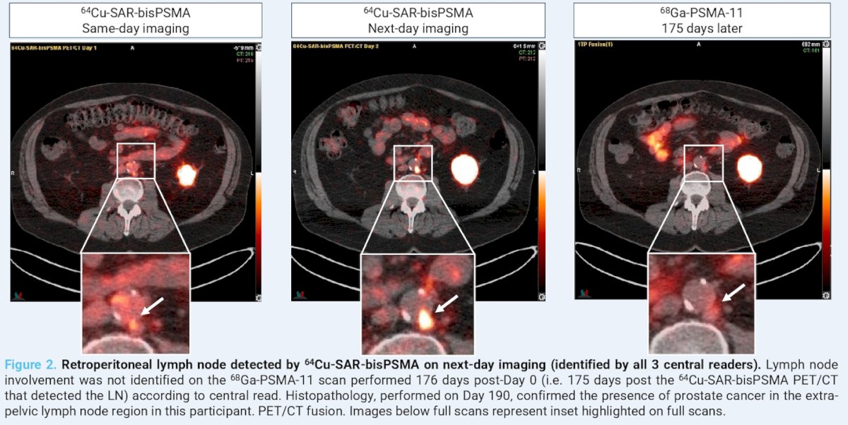 Dr. Nordquist highlighted a representative case in which ⁶⁴Cu-SAR-bisPSMA PET/CT identified pelvic nodal involvement that had not been detected on a subsequent ⁶⁸Ga-PSMA-11 PET/CT performed 175 days later. On next-day imaging, a retroperitoneal lymph node was identified by all three central readers using ⁶⁴Cu-SAR-bisPSMA. This lesion was not visualized on the ⁶⁸Ga-PSMA-11 scan obtained 176 days after baseline (Day 0). Histopathologic confirmation on Day 190 verified the presence of prostate cancer in the extra-pelvic lymph node.&nbsp;