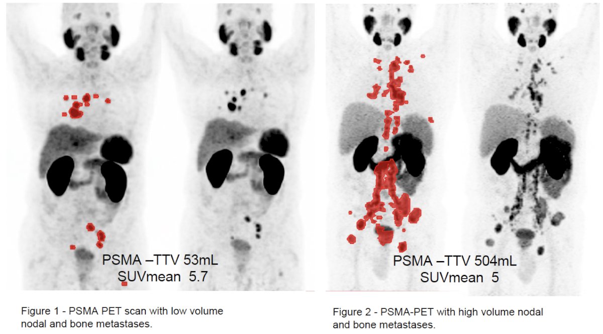 The median PSMA total tumor volume (PSMA-TTV) in the study cohort was 28 mL (CHAARTED high volume: 61 mL; CHAARTED low volume: 22 mL), with the highest PSMA TTV quartile (Q4) defined at >71mL.&nbsp;
