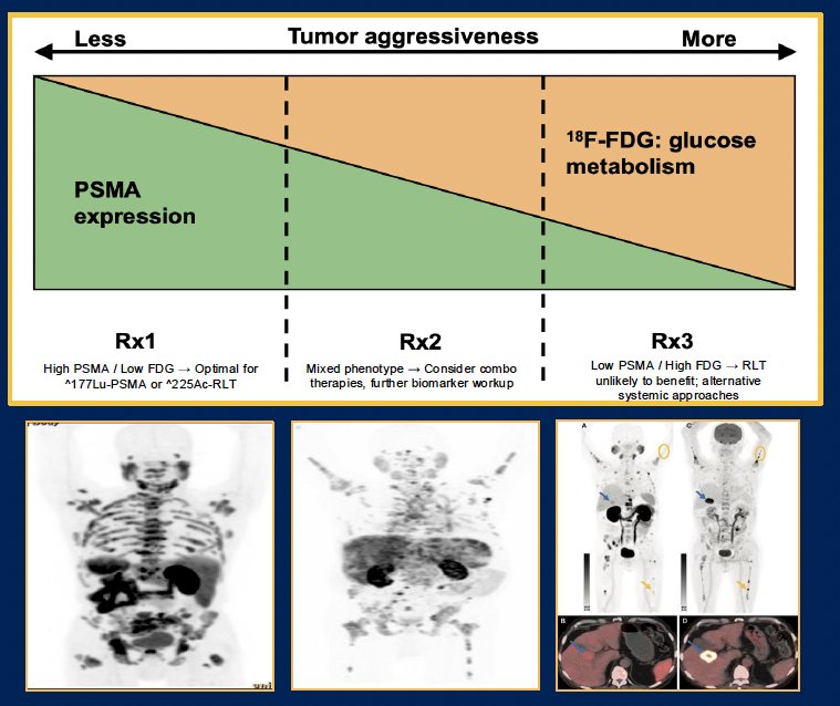 Discussing heterogeneity of PSMA expression and tumor plasticity, Dr. Garcia highlighted the following key points: