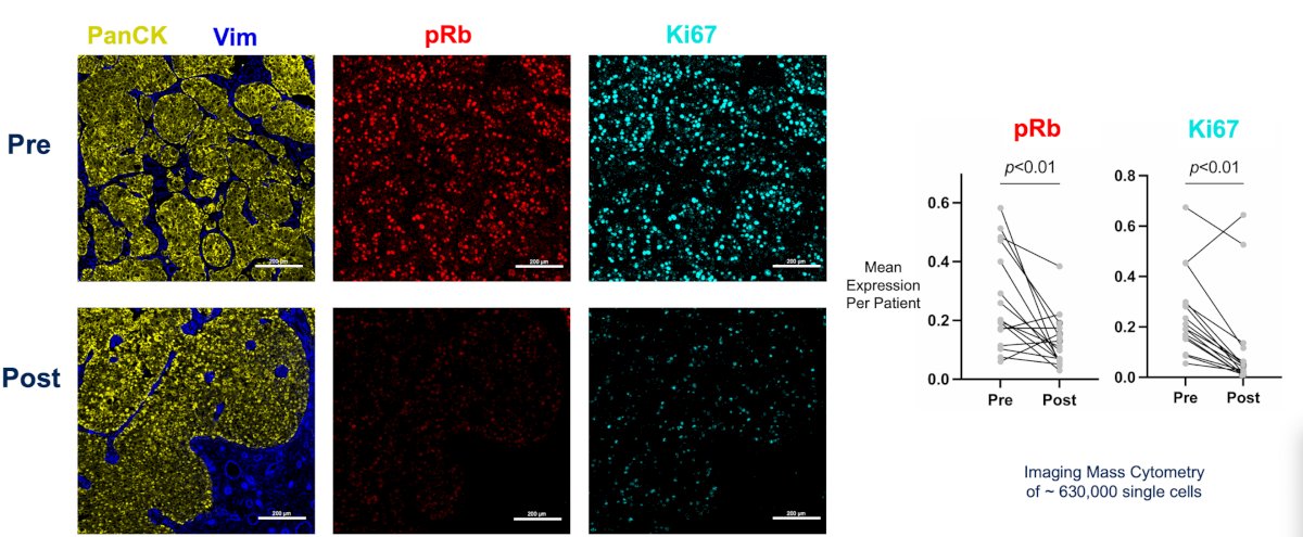 Imaging mass cytometry of pre- and post-abemaciclib tissues showed a significant reduction in RB1 phosphorylation after abemaciclib confirming on-target activity