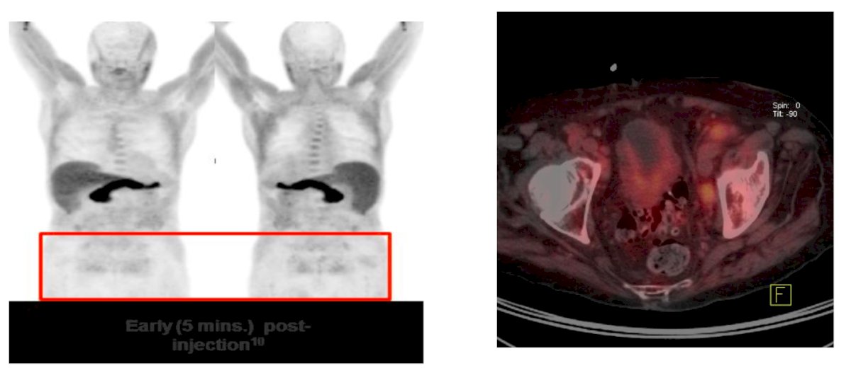 18F - AXUMIN PET/CT ¹⁸F-Fluciclovine (Axumin) PET/CT is an FDA-approved imaging modality for detecting recurrent prostate cancer in patients with rising PSA after initial therapy. This synthetic amino acid analog targets amino acid transporters upregulated in prostate cancer cells. A key advantage is minimal urinary excretion, allowing for clearer pelvic imaging compared to other tracers. It is particularly useful in identifying recurrence in prostate/prostate bed and regional lymph nodes. However, its sensitivity declines at low PSA levels, and it lacks the specificity and lesion-to-background contrast of PSMA-based imaging