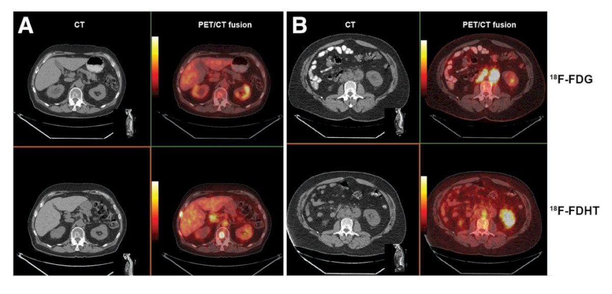 Dr. Gamie further discussed emerging molecular imaging approaches, including [¹⁸F]-fluorodihydrotestosterone ([¹⁸F]FDHT) PET, which directly targets the androgen receptor. This modality holds promise as both a prognostic and predictive biomarker in metastatic castration-resistant prostate cancer (mCRPC), potentially offering real-time insights into AR expression and guiding therapy selection in advanced disease.