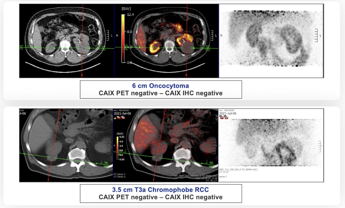 Two examples of negative cases included negative 89Zr-girentuximab PET imaging suspecting a benign lesion or non-clear cell RCC, with one patient having a 6 cm oncocytoma, and the other patient have a T3a chromophobe RCC: