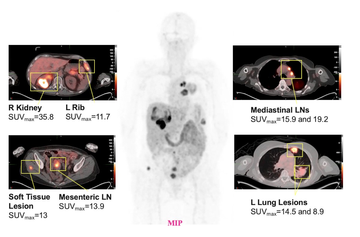 Another case was of a 68 year old female patient with metastatic RCC (clear cell and rhabdoid features), with a 89Zr-girentuximab PET scan showing a right kidney mass SUVmax 35.8, a left rib lesion SUVmax 11.7, mediastinal lymph nodes (SUVmax 15.9 and 19.2), soft tissue lesion SUVmax 13, mesenteric lymph node SUV max 13.9, and lung lesions (SUVmax 14.5 and 8.9):