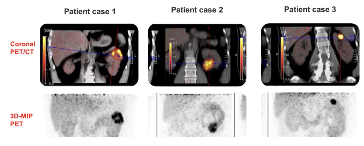 89Zr-DFO-girentuximab enables excellent visualization and characterization of renal masses: