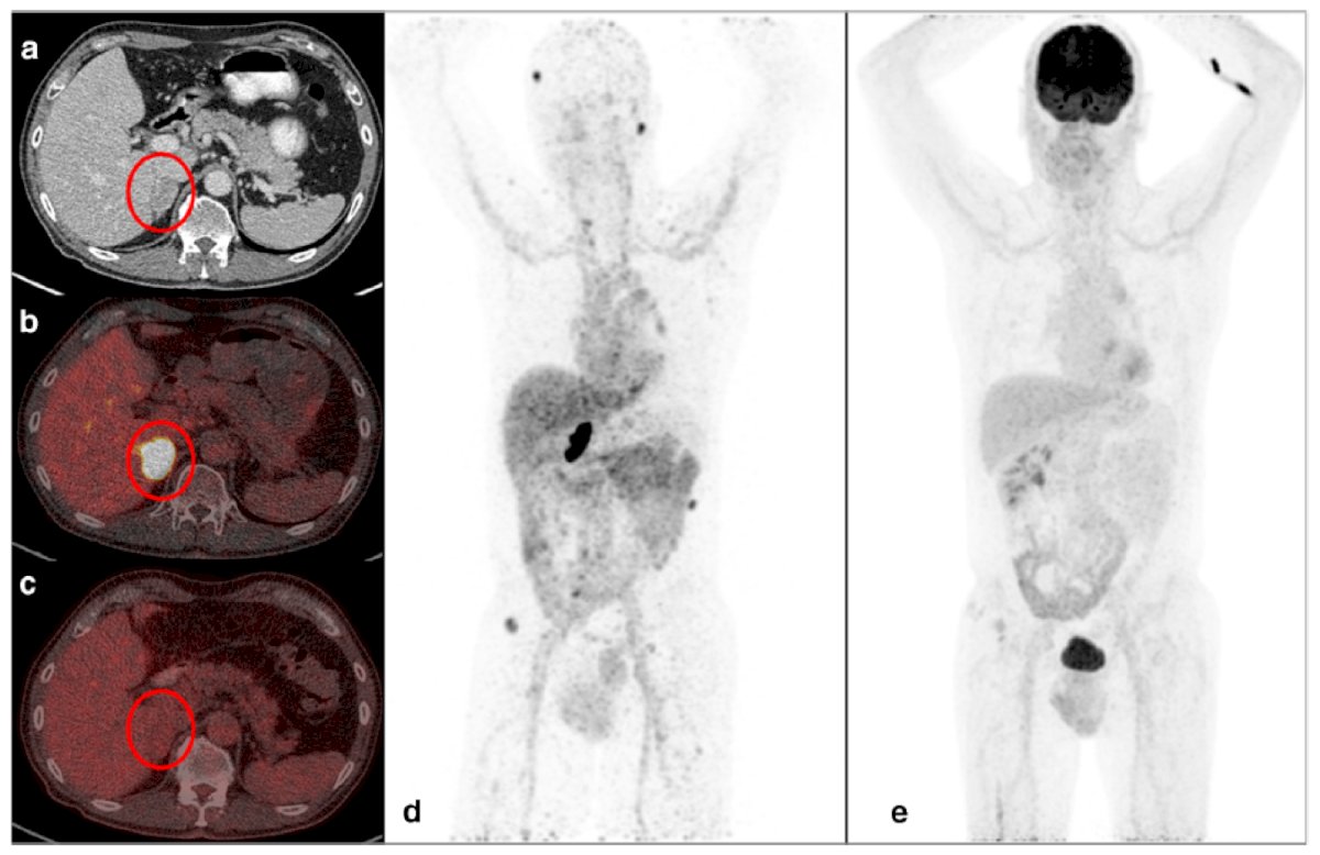 The IMPACT-RCC study [7] evaluated visualization of clear cell RCC lesions in 42 patients with metastatic disease (n = 449 lesions). Patients in this study had a lesion size cutoff of 1 cm (lymph nodes up to 1.5 cm), with ultimately 56% of lesions visualized on CT, 59% visualized on 18FDG-PET/CT, and 70% visualized on 89Zr-girentuximab PET: