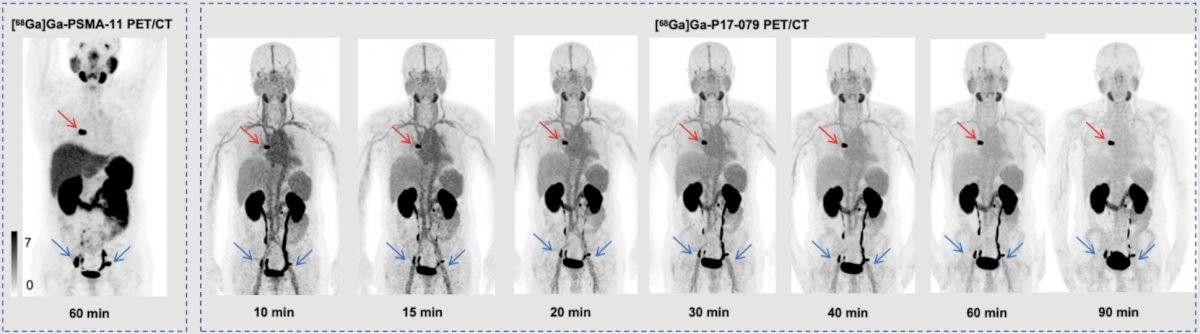A total of three prostate cancer patients with bone metastases were enrolled in this study. All patients underwent 68Ga-PSMA-11 PET/CT imaging first, followed by 90-minute dynamic imaging with 68Ga-P17-079 PET/CT within one week: