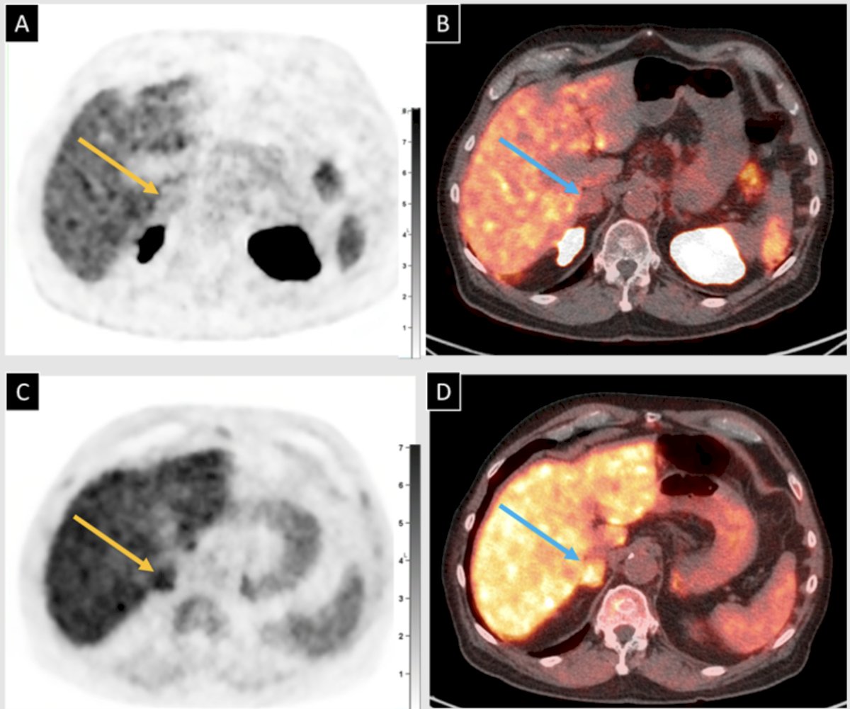 The following patient had biochemical recurrence with a PSA of 2.61 ng/mL. 18F-Piflufolastat PET/CT is shown in panel A (axial PET) and axial fused PET/CT shown in panel B, demonstrating a 2 cm right adrenal nodule present without PSMA uptake, which was interpreted as negative. 18F-fluciclovine PET/CT 25 days later is depicted in an axial PET in panel C and an axial fused PET/CT in panel D. This showed abnormal uptake in the right adrenal nodule, suspicious for metastasis, with a biopsy of this nodule confirming metastatic prostate adenocarcinoma: