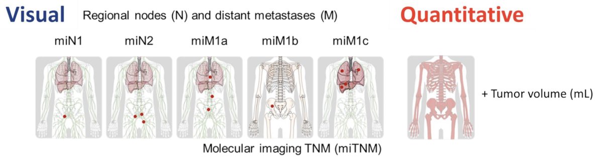 The investigators obtained total lesion count, total tumor volume, PSMA expression score and overall survival follow-up. Considering site characteristics, they split the investigator sites 2:1 into development and validation cohorts. PPP predictors were assessed and created version 2 for visual and quantitative PPP2 nomograms based on Cox regression models with least absolute shrinkage and selection operator penalty for overall survival using the development cohort. The visual and quantitative PSMA PET metrics are highlighted as follows:
