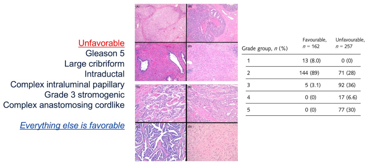  Features such as Gleason 5, large cribriform, intraductal, complex intraluminal papillary, grade 3 stromogenic, and complex anastomosing cordlike patterns were identified as clearly unfavorable, while everything else was considered favorable. Importantly, the data showed that while most grade group 2 cases were favorable, higher-grade groups were increasingly dominated by these unfavorable morphologies, reinforcing the need to move beyond traditional Gleason grouping when assessing risk.