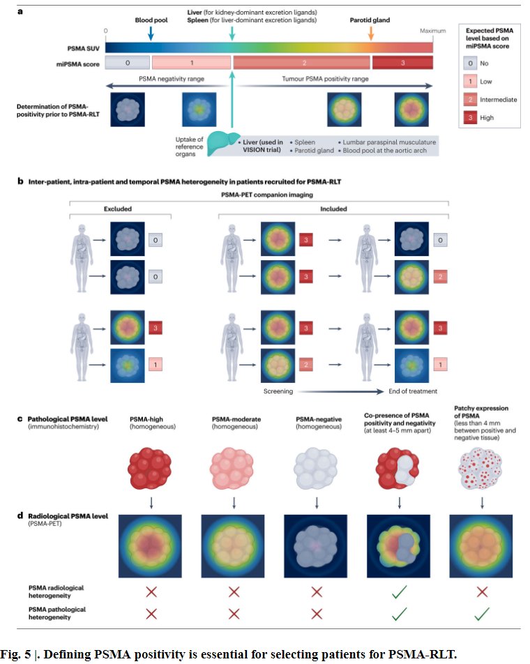 Defining PSMA positivity is essential when determining eligibility for PSMA-targeted radioligand therapy. As illustrated, PSMA uptake varies across lesions, with heterogeneity observed both between and within patients over time. The miPSMA scoring system helps standardize assessment, distinguishing PSMA-negative from positive disease and guiding trial inclusion, as in VISION. Importantly, heterogeneity at the pathological or radiological level can result in patchy PSMA expression, underscoring the need for careful selection to optimize outcomes and opening opportunities for research in this field. This reinforces the principle that theranostic treatment in prostate cancer must be personalized, balancing imaging findings, tumor biology, and clinical context.