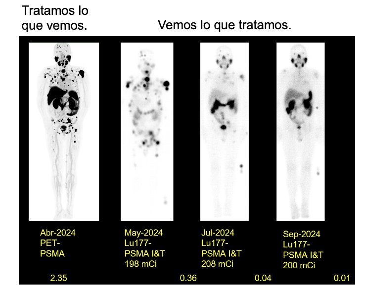 Dr. Granados emphasized one of the unique advantages of radioligand therapy (RLT): the ability to both “treat what we see” and “see what we treat.” He illustrated this with the case of a patient who underwent therapy with 177Lu-PSMA. On baseline imaging, the patient had extensive disease, but after three treatment cycles, follow-up PET/CT demonstrated near complete resolution of disease activity with no evidence of residual disease, underscoring the precision and therapeutic impact of PSMA-targeted R.