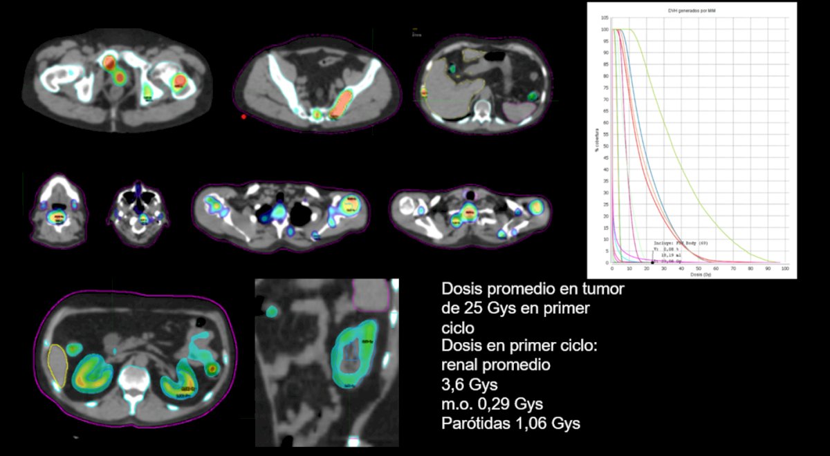 Another critical aspect is the difference between activity and dose in RLT. While activity (measured in Ci/mCi or Bq/MBq) represents the prescribed amount of radioactivity administered, the absorbed dose (measured in Gy) reflects the actual radiation delivered to the tumor and organs at risk. Importantly, imaging-based dosimetry allows quantification of tumor dose versus limiting doses in critical organs. For example, as shown below, a patient receiving RLT achieved an average tumor dose of 25 Gy after the first cycle, but also absorbed 3.6 Gy in the kidneys, 0.29 Gy in the bone marrow, and 1.06 Gy in the parotid glands. These data highlight the delicate balance between maximizing tumor control and minimizing toxicity, underscoring the importance of individualized dosimetry in treatment planning.