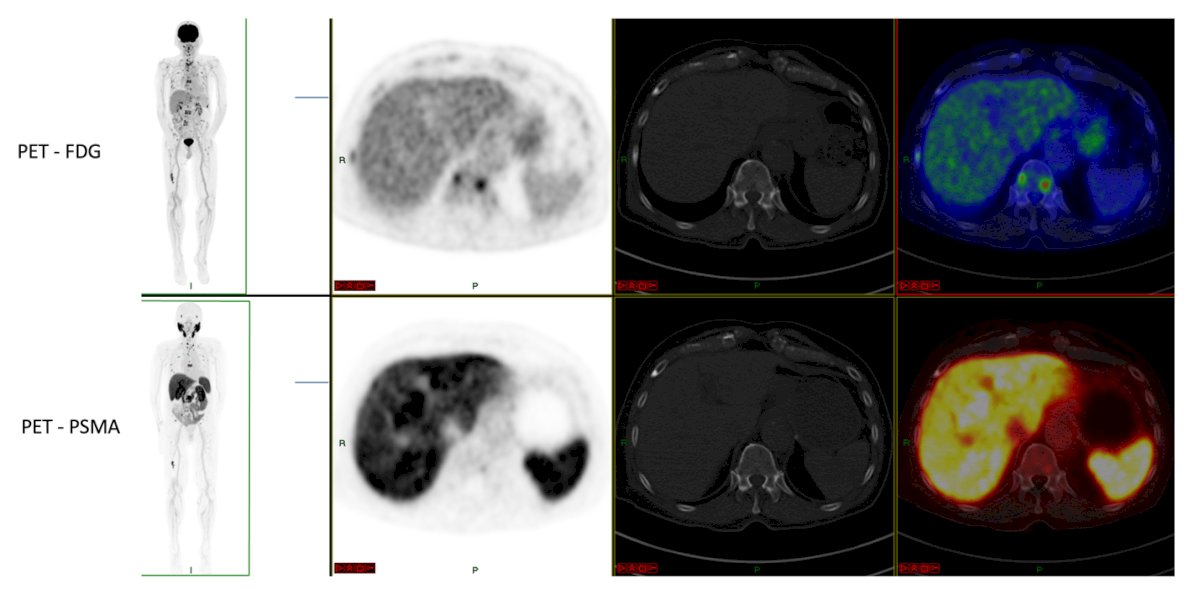 Dr. Granados emphasized that prostate cancer is characterized by marked tumor heterogeneity, which directly impacts the use of theranostics. While some lesions demonstrate strong PSMA uptake, others may only be detected with FDG radiotracers as shown below, leaving a subset of patients ineligible for PSMA-targeted therapies. This variability underscores the complexity of PSMA heterogeneity and highlights the need for a more nuanced, personalized approach in determining which patients are most likely to benefit from theranostic treatment strategies and still to be determined if we should be doing both PSMA and FDG PET/CTs on these patients.