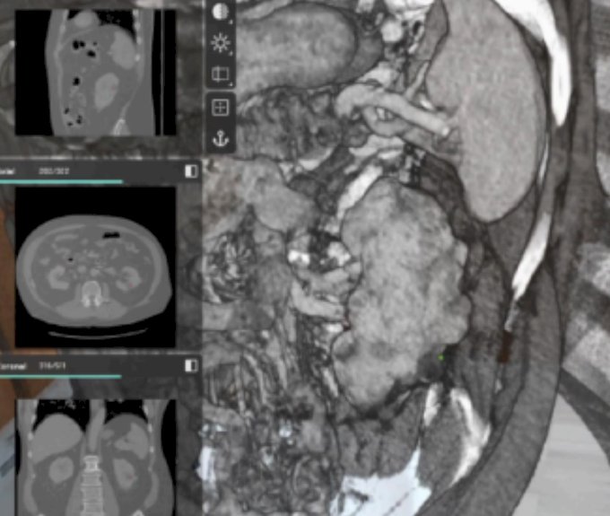 Figure 1: 3D Visualization of Renal Mass