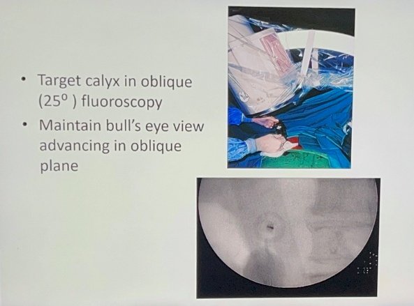Dr. Vernon Pais opened the panel by presenting fluoroscopy use in PCNL access. He described the use of contrast to highlight infundibula and the benefits of spilling air for better visualization. Fluoroscopy can provide geometric approaches for targeting calyces, including triangulation, biplanar modification, and bull’s eye techniques. Triangulation involves geometric adjustments in the AP and lateral planes to reduce torque on the lower pole. Biplanar (0-90°) modification combines AP and lateral views with access at the intersection. This versatile technique can be applied in either prone or supine positioning. The bull’s eye technique involves aligning the needle tip and hub into a concentric target to gain access to the shortest path to the calyx. He emphasized that despite the advent of ultrasound and robotic systems, fluoroscopy cannot be replaced: “It’s the key tool you always want available in the room.”